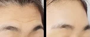 Facial Contour & Forehead Before & After — Restory Plastic Surgery