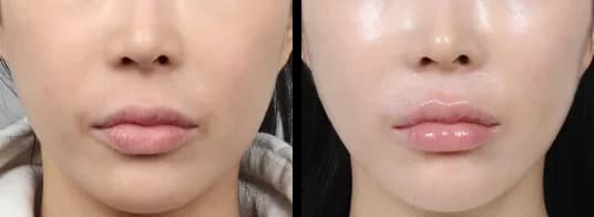 Facial Contour & Forehead Before & After — Restory Plastic Surgery