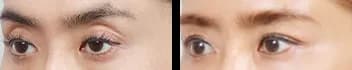 Eyes Before & After — Restory Plastic Surgery
