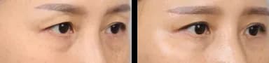 Eyes Before & After — Restory Plastic Surgery