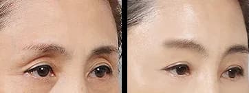 Facial Contour & Forehead Before & After — Restory Plastic Surgery