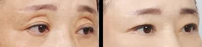 Eyes Before & After — Restory Plastic Surgery