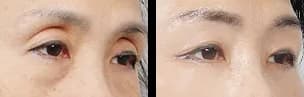 Eyes Before & After — Restory Plastic Surgery
