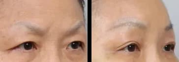 Facial Contour & Forehead Before & After — Restory Plastic Surgery