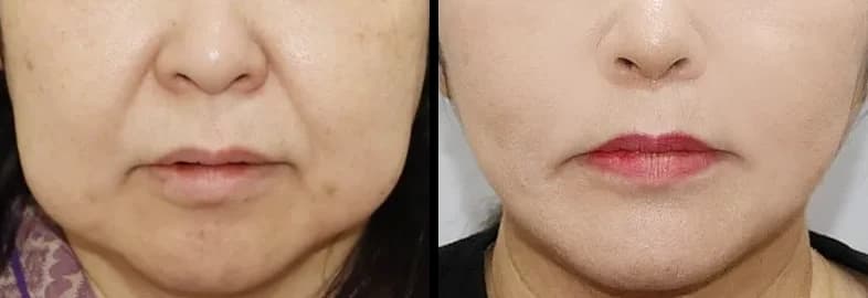 Jaw, lip & dental Before & After — Restory Plastic Surgery