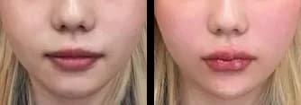 Skin Before & After — Restory Plastic Surgery
