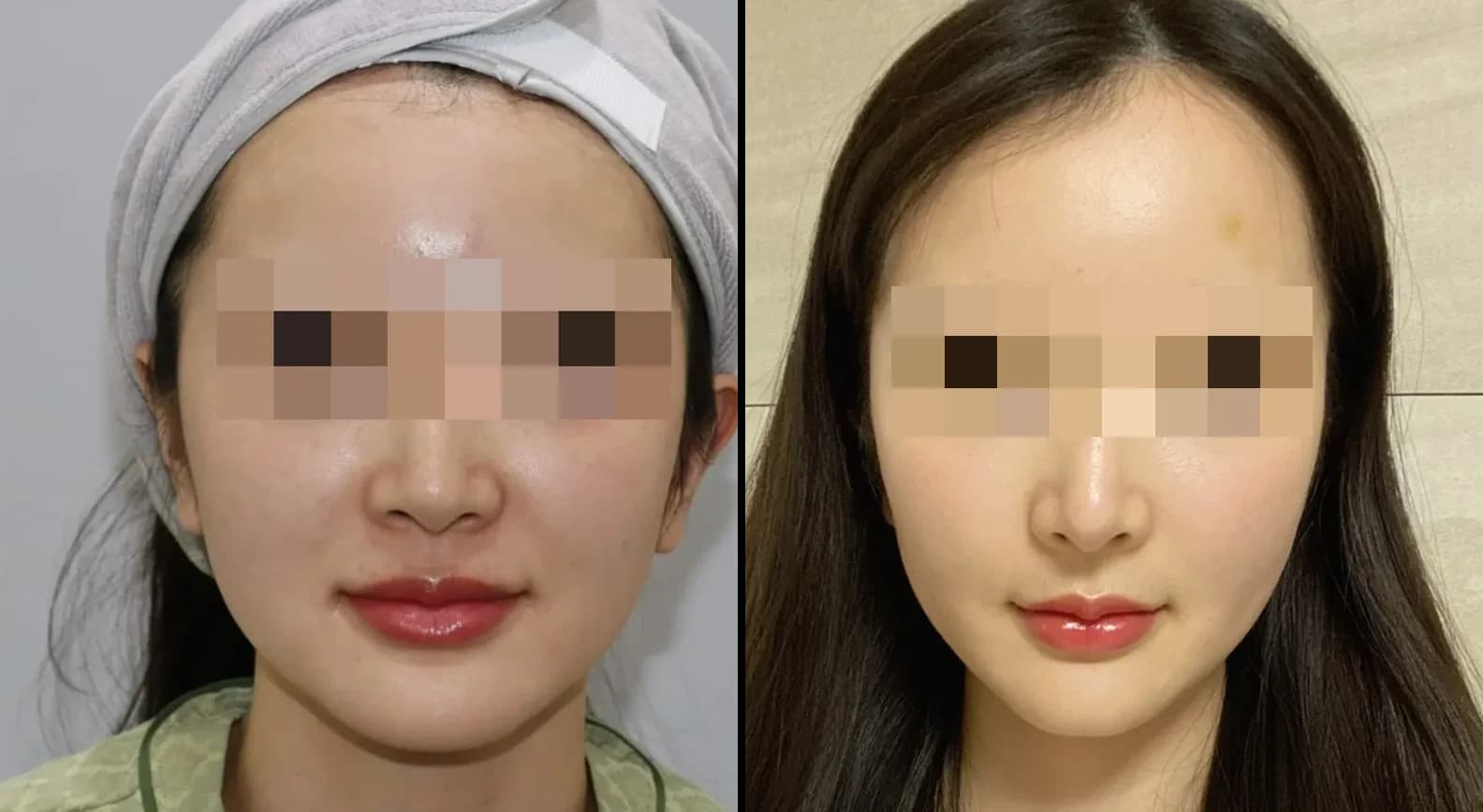 Skin Before & After — Restory Plastic Surgery