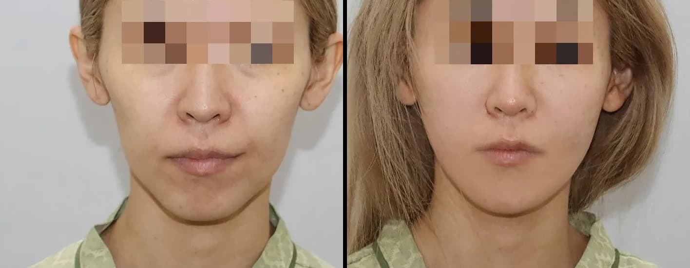 Skin Before & After — Restory Plastic Surgery
