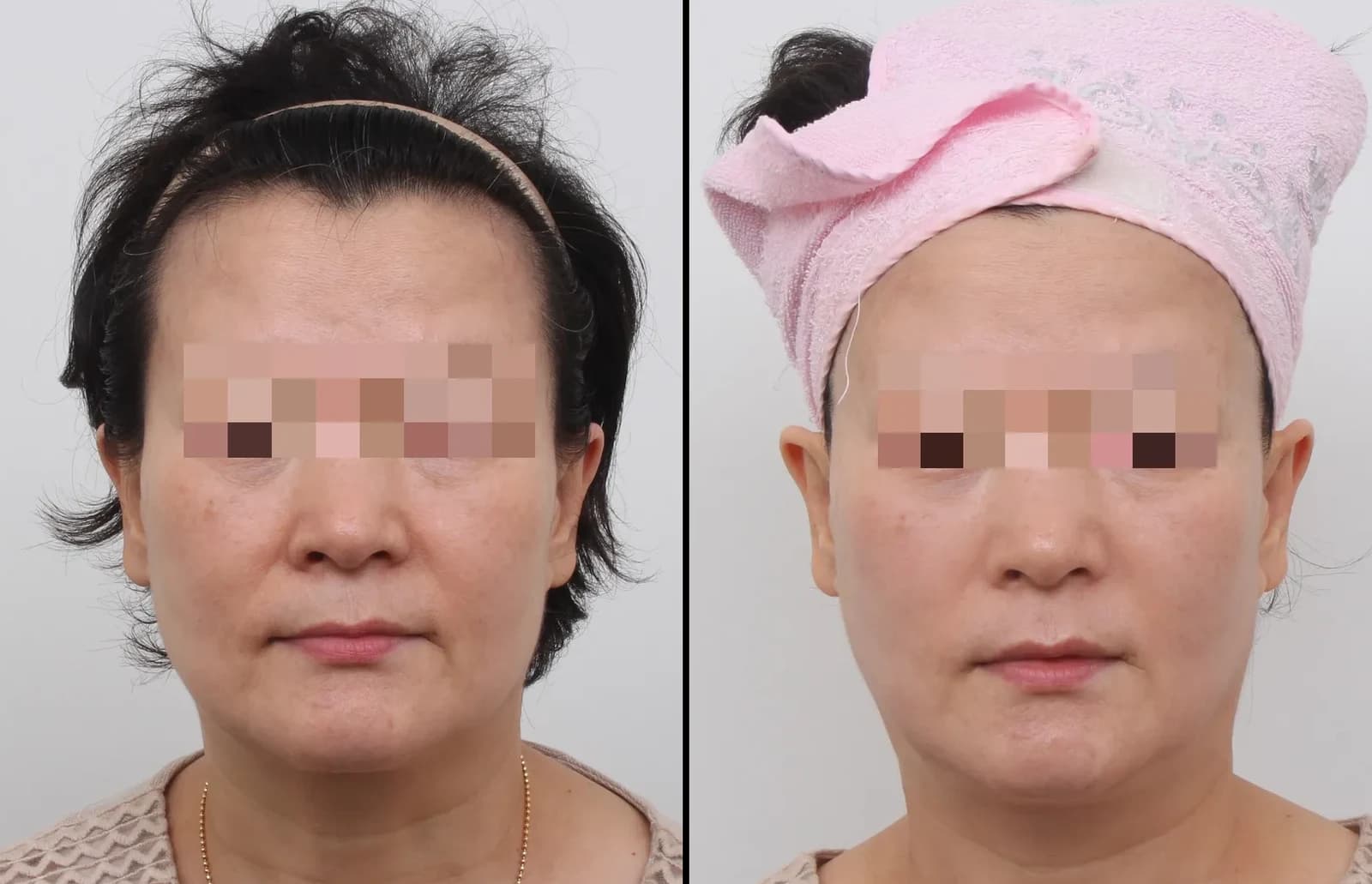Skin Before & After — Restory Plastic Surgery