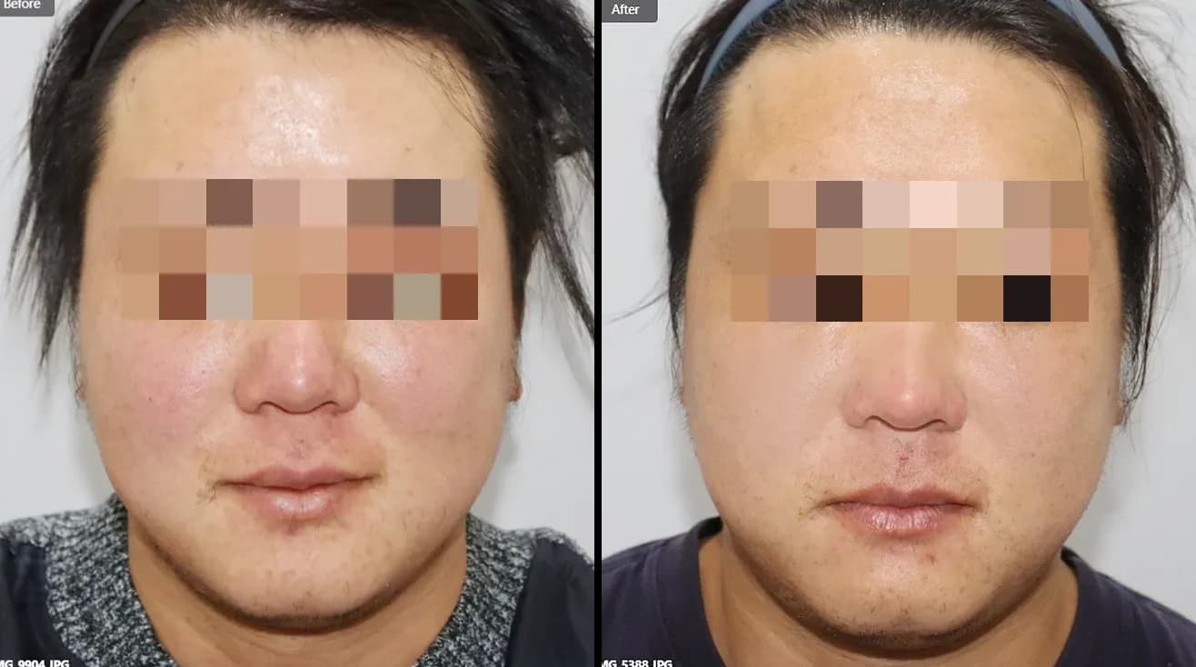 Skin Before & After — Restory Plastic Surgery