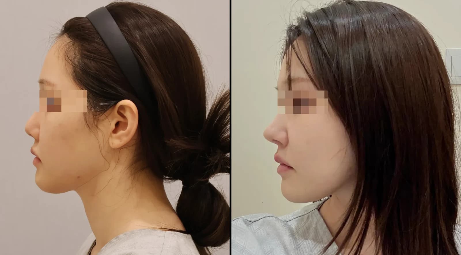 Nose Before & After — Restory Plastic Surgery