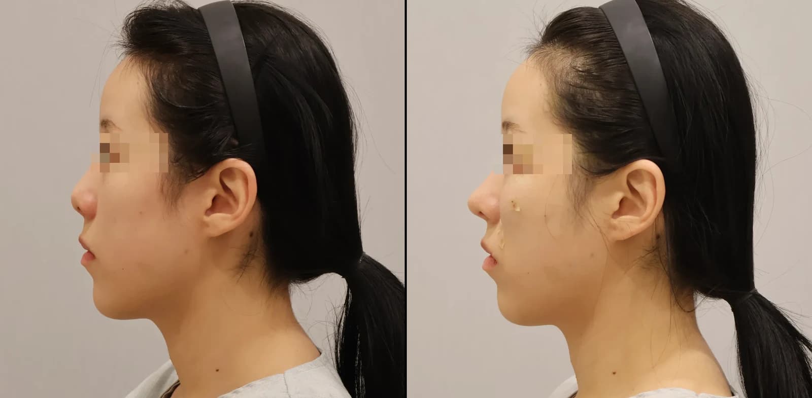 Nose Before & After — Restory Plastic Surgery