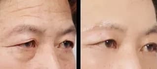 Facial Contour & Forehead Before & After — Restory Plastic Surgery